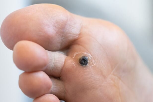 Home Remedies vs. Professional Treatments for Warts