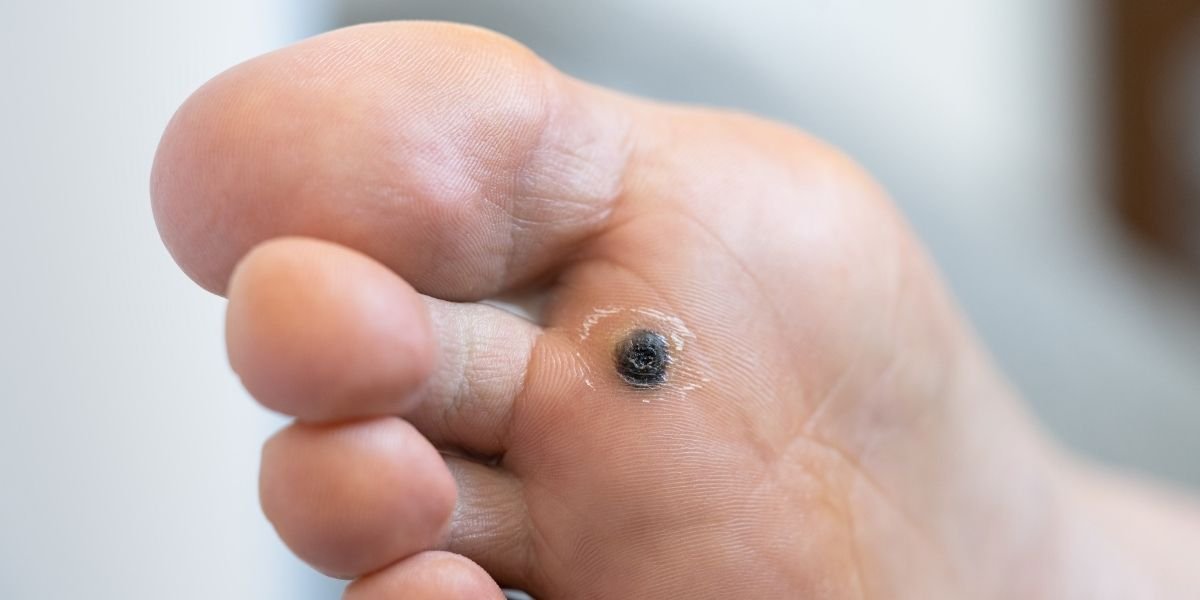 Home Remedies vs. Professional Treatments for Warts