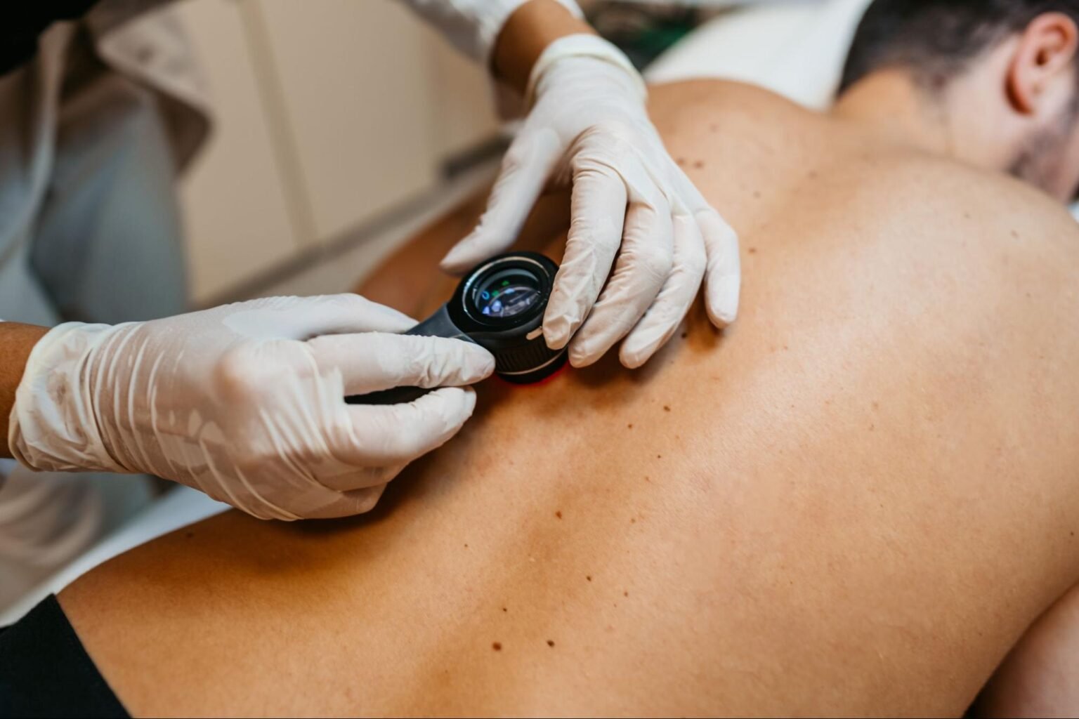 Insights from Mohs Surgeons on Skin Cancer