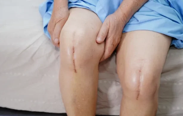 Preparing for Your Upcoming Knee Replacement Surgery