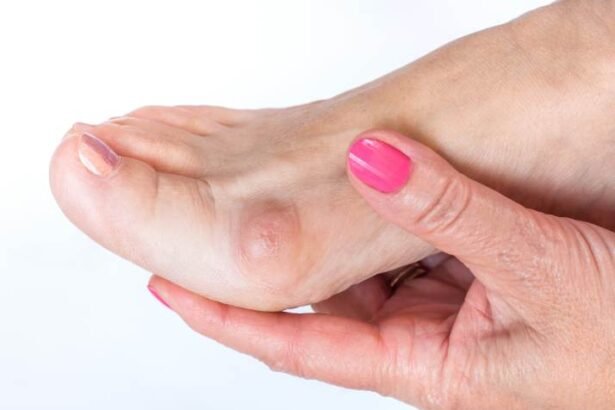 Recognizing Signs of Bunions