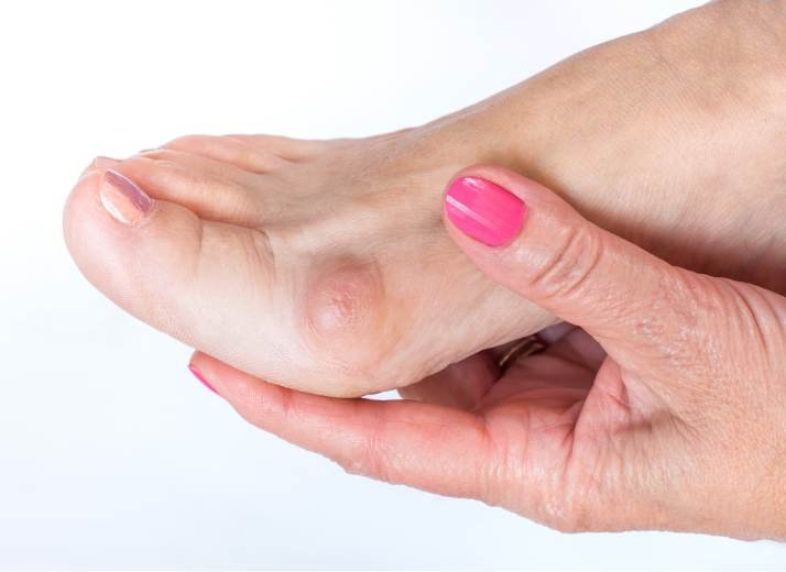 Recognizing Signs of Bunions