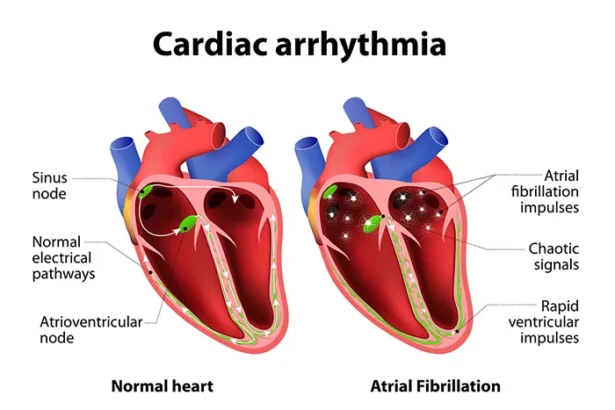 The Connection Between Atrial Fibrillation and Stroke Risk