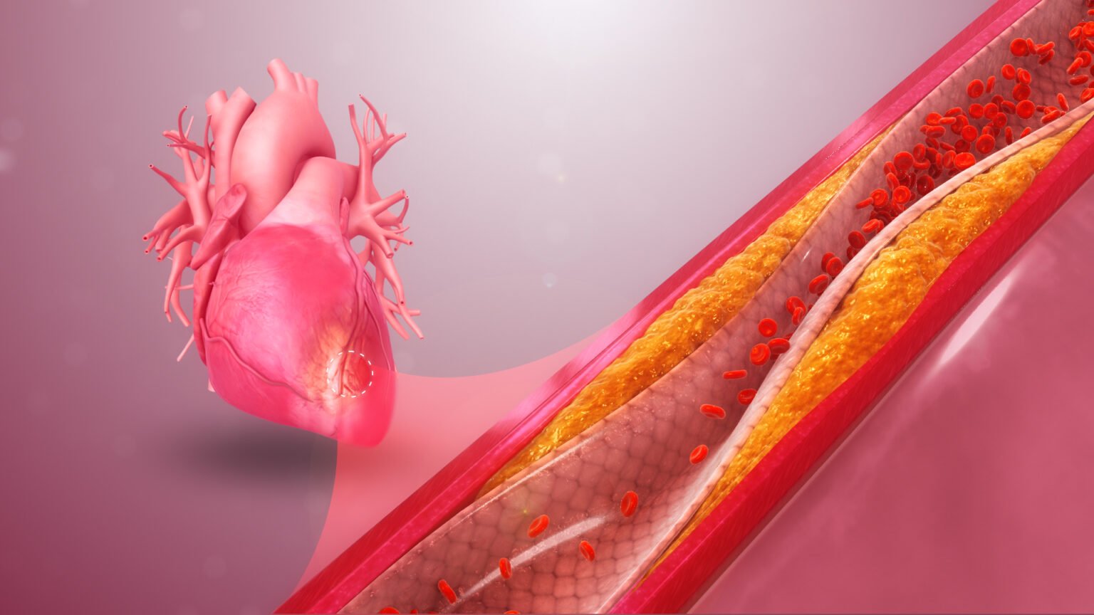 Understanding Coronary Artery Disease