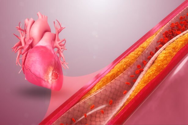 Understanding Coronary Artery Disease
