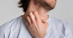Understanding Personalized Eczema Treatment Plans