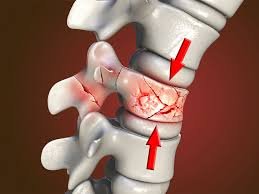 Understanding the Role of Kyphoplasty in Treating Spinal Compression Fractures