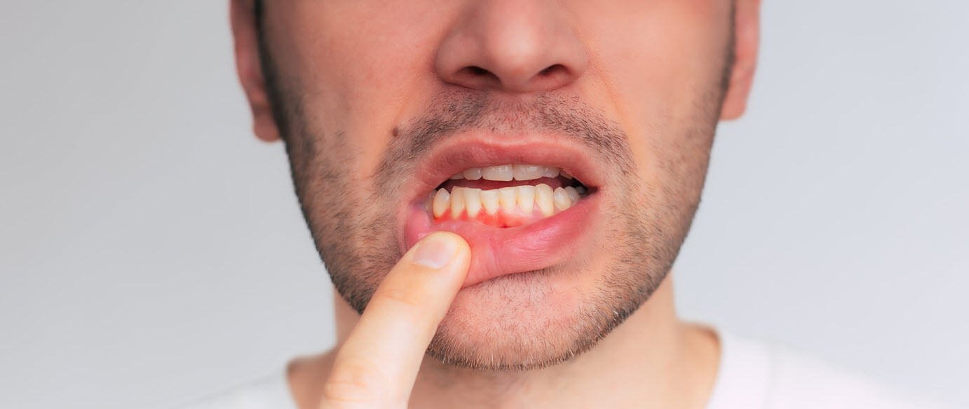 Gum Treatments That Can Help Reverse Early Gum Disease
