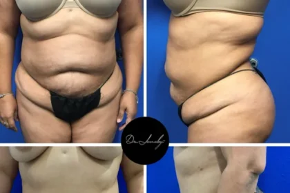 How To Promote a Safe and Successful Tummy Tuck