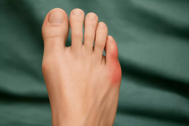 The Connection Between Bunions and Foot Hygiene