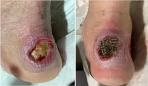The Impact of Treating Wounds Properly