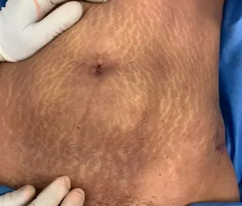 Using QuantumRF for Body Sculpting and Firming