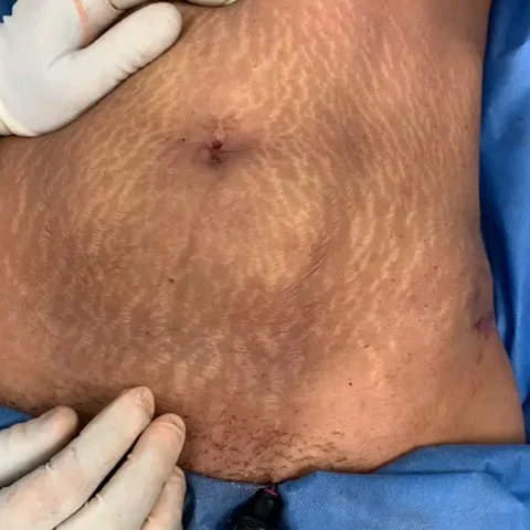 Using QuantumRF for Body Sculpting and Firming