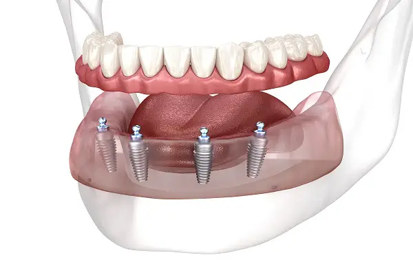 What To Expect During Treatment for the All-on-4 Procedure