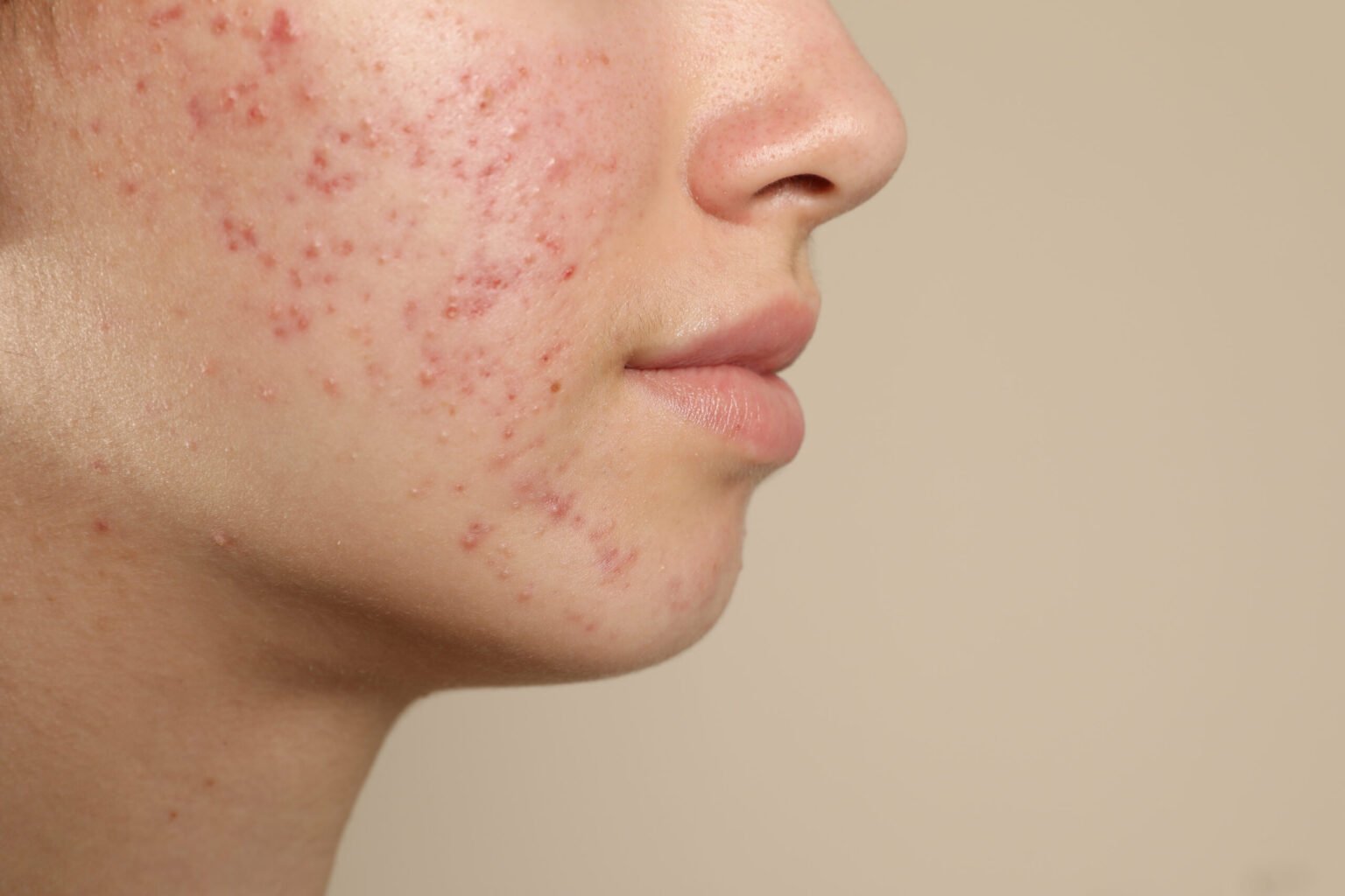 Combining Treatments for Eczema and Acne Care