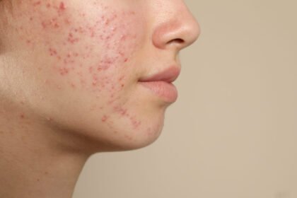 Combining Treatments for Eczema and Acne Care