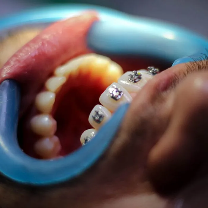The Different Types of Orthodontic Treatments Available for All Ages