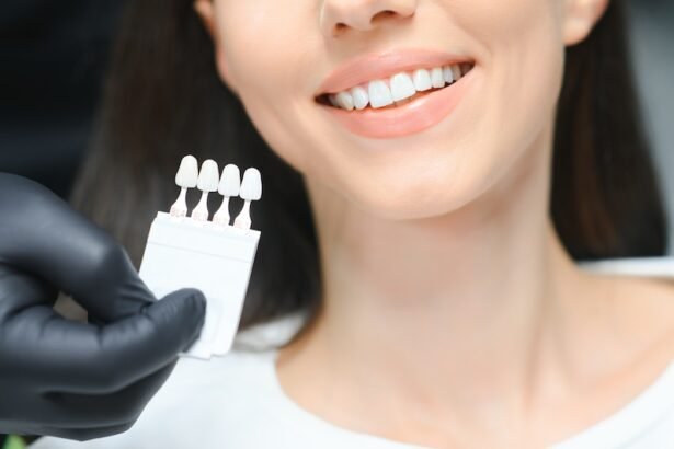 What Is the Process of Getting Veneers