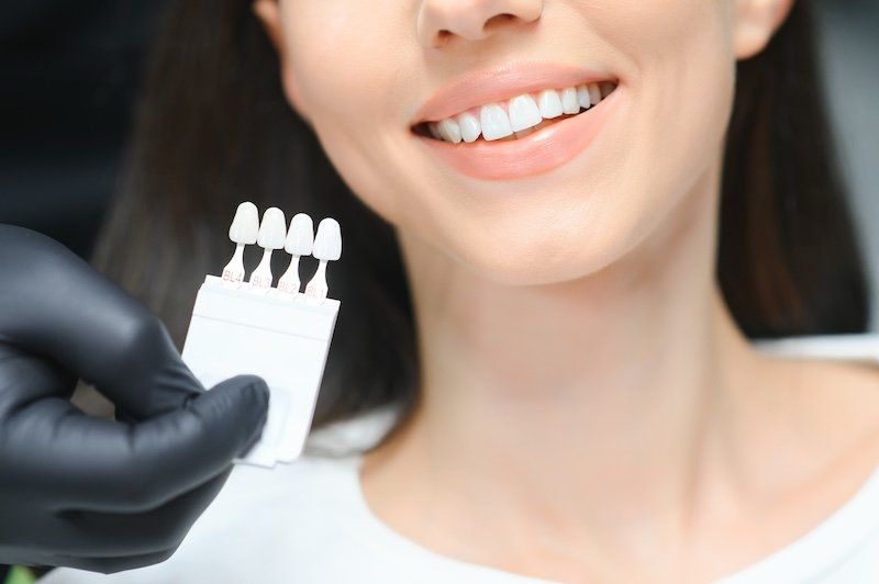 What Is the Process of Getting Veneers