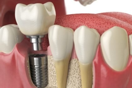 What To Expect During the Dental Implant Procedure