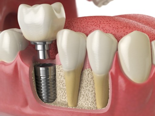 What To Expect During the Dental Implant Procedure