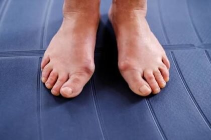 Understanding the Long-term Effects of Untreated Bunions