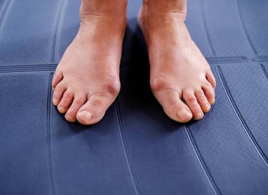Understanding the Long-term Effects of Untreated Bunions