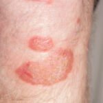 Understanding How Treating Psoriasis Prevents Other Health Conditions