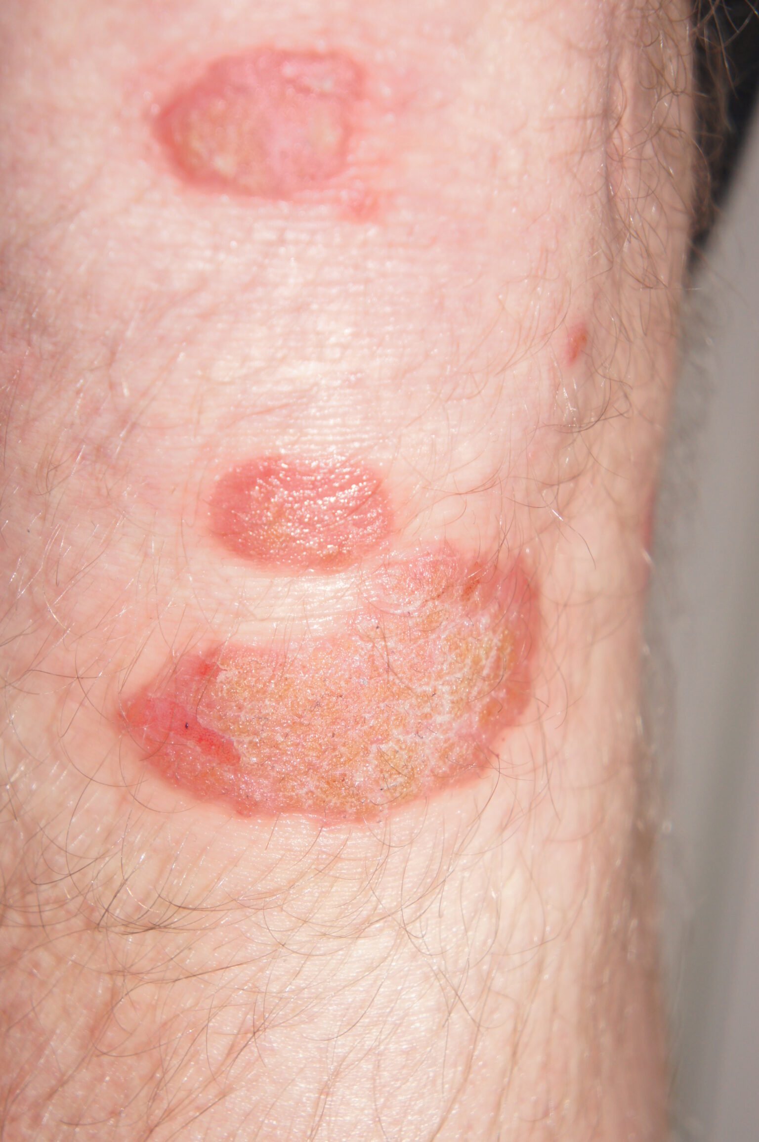 Understanding How Treating Psoriasis Prevents Other Health Conditions