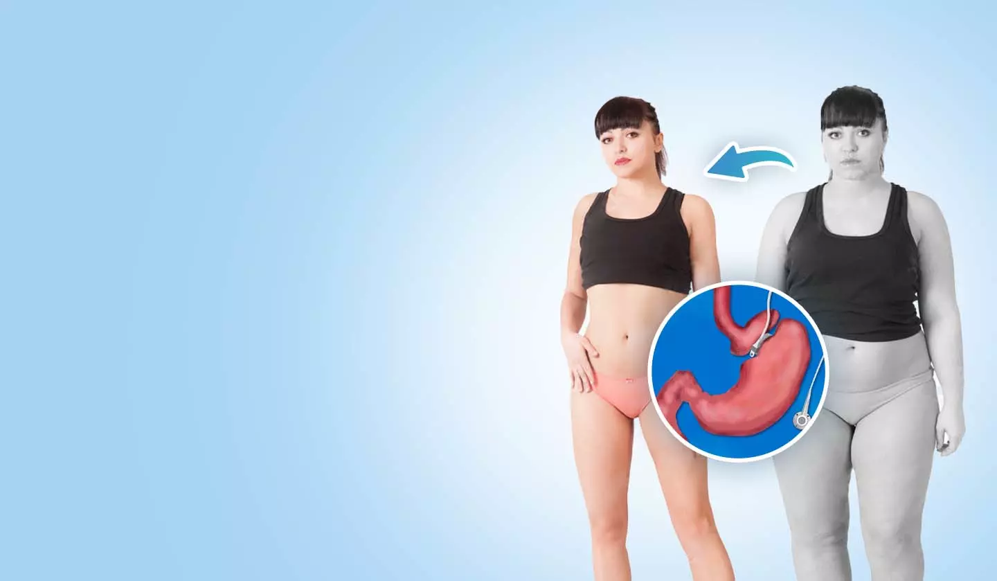 What To Expect Before and After Bariatric Surgery